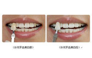爆料牙齿美白是真的吗视频,视频爆料揭示真实效果 第1张 爆料牙齿美白是真的吗视频,视频爆料揭示真实效果 第1张